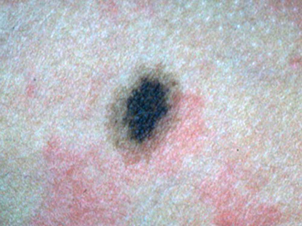 nevus, congenital