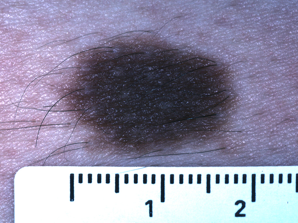 nevus, congenital