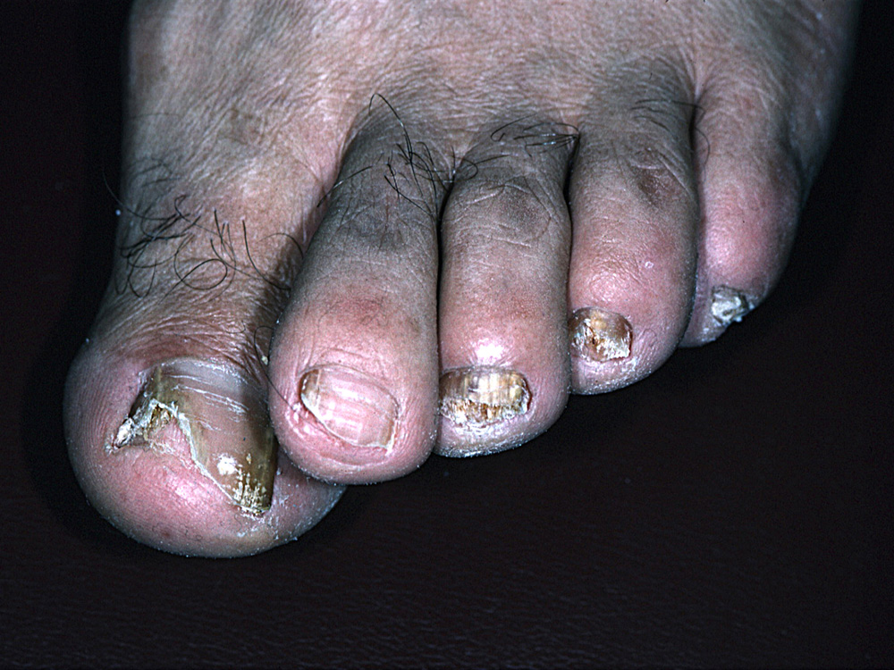 onychomycosis