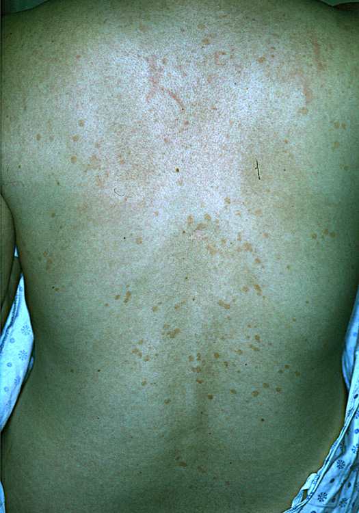 pityriasis rosea
