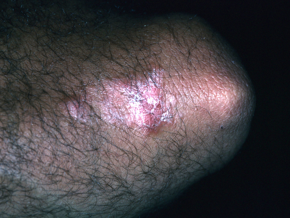 psoriasis
