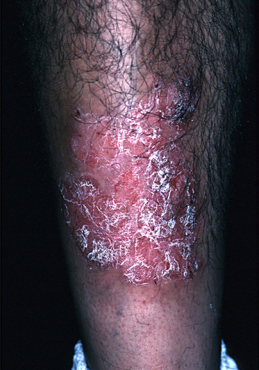 psoriasis