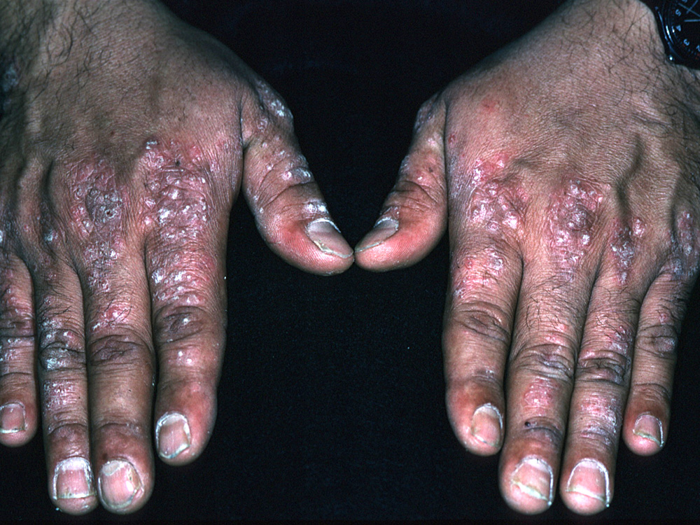 psoriasis