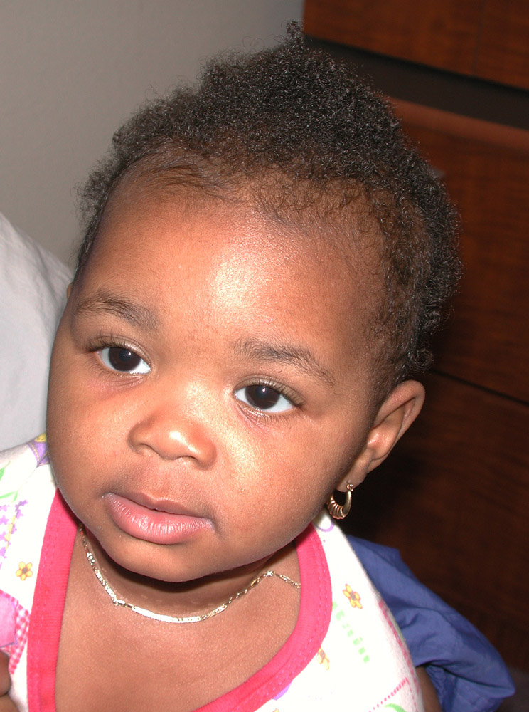 atopic dermatitis