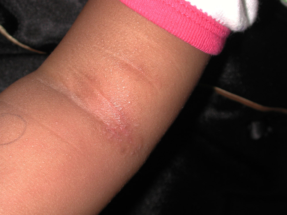 atopic dermatitis