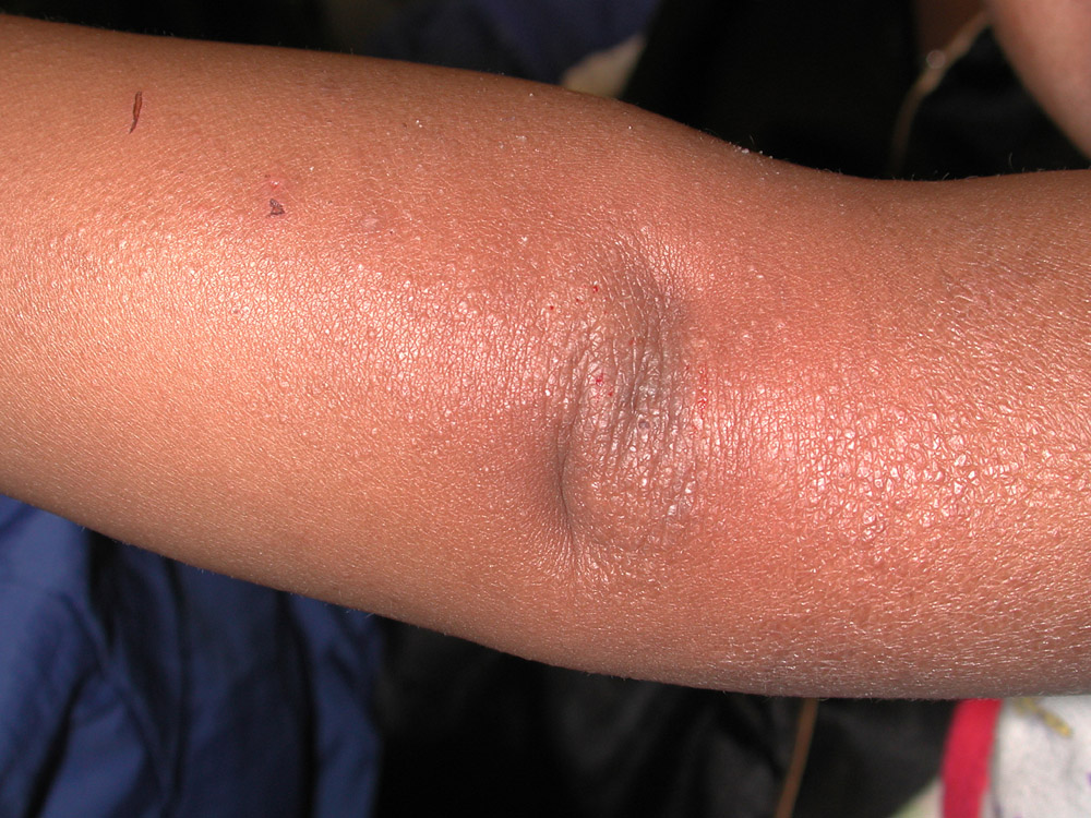 atopic dermatitis