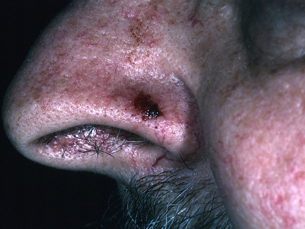 basal cell carcinoma, nodular