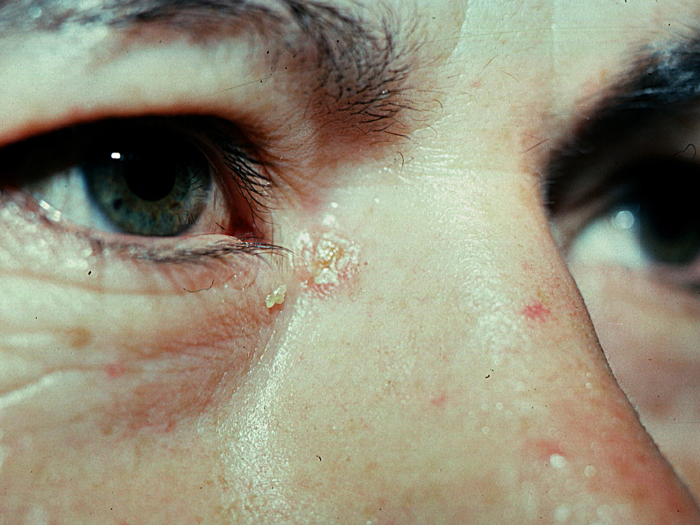 squamous cell carcinoma