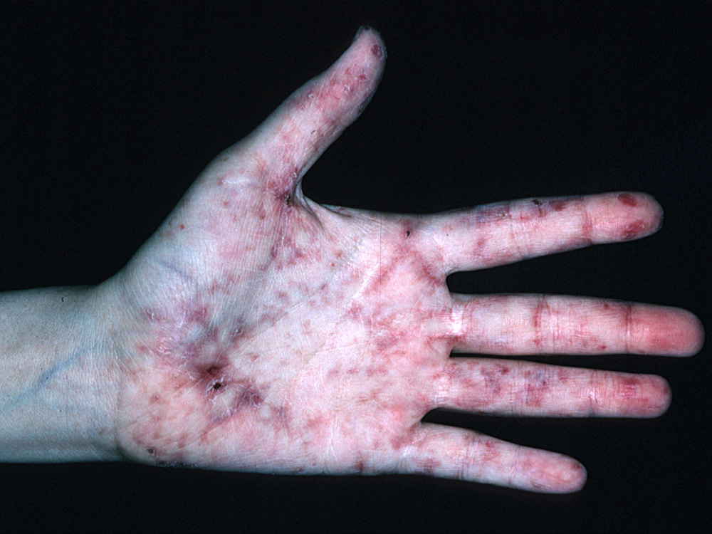 lupus erythematosus, systemic