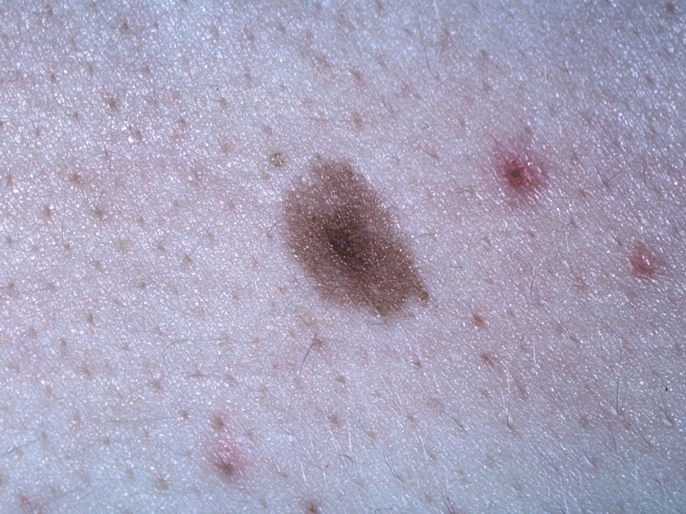 nevus, dysplastic