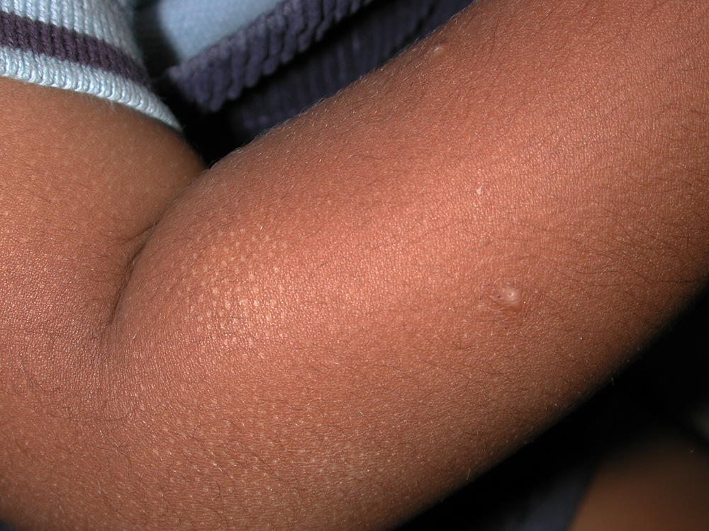atopic dermatitis
