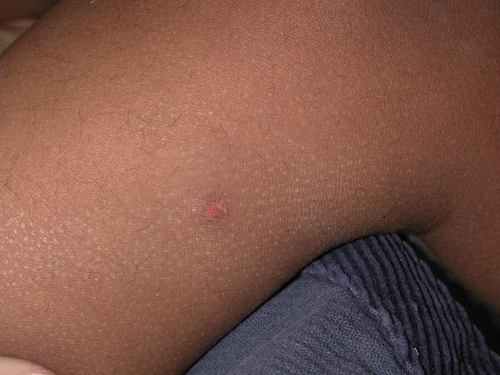 atopic dermatitis
