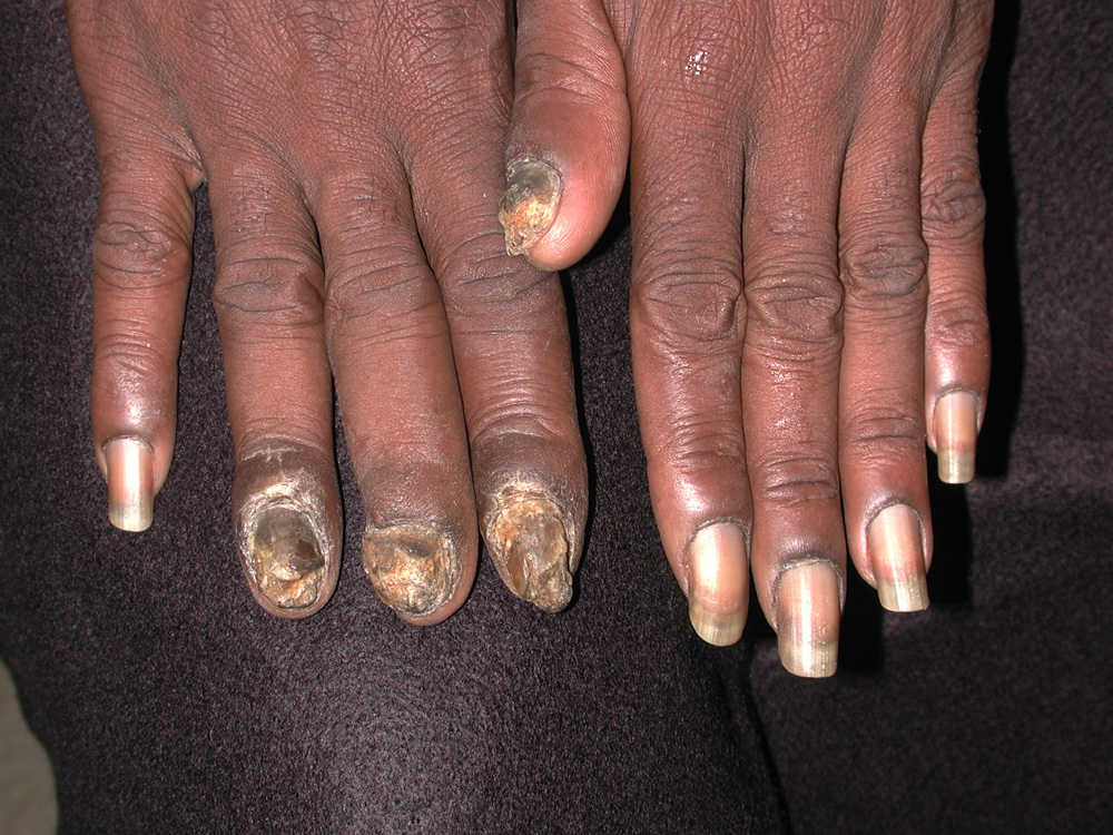 onychomycosis