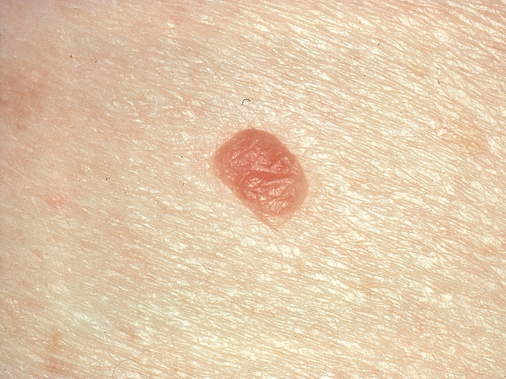 nevus, dermal