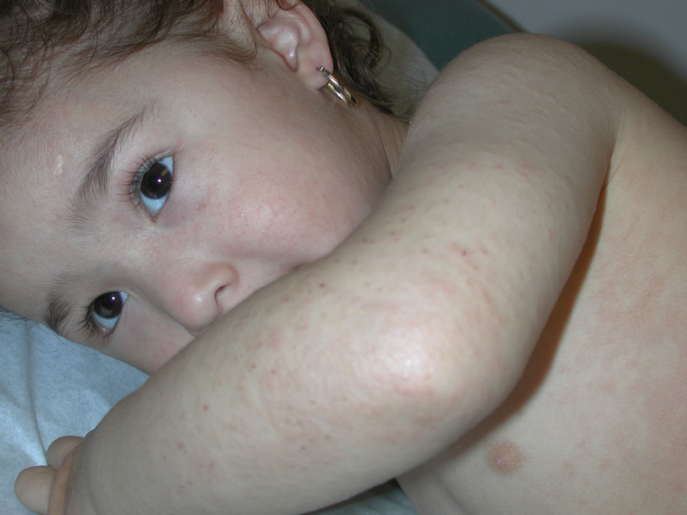 atopic dermatitis