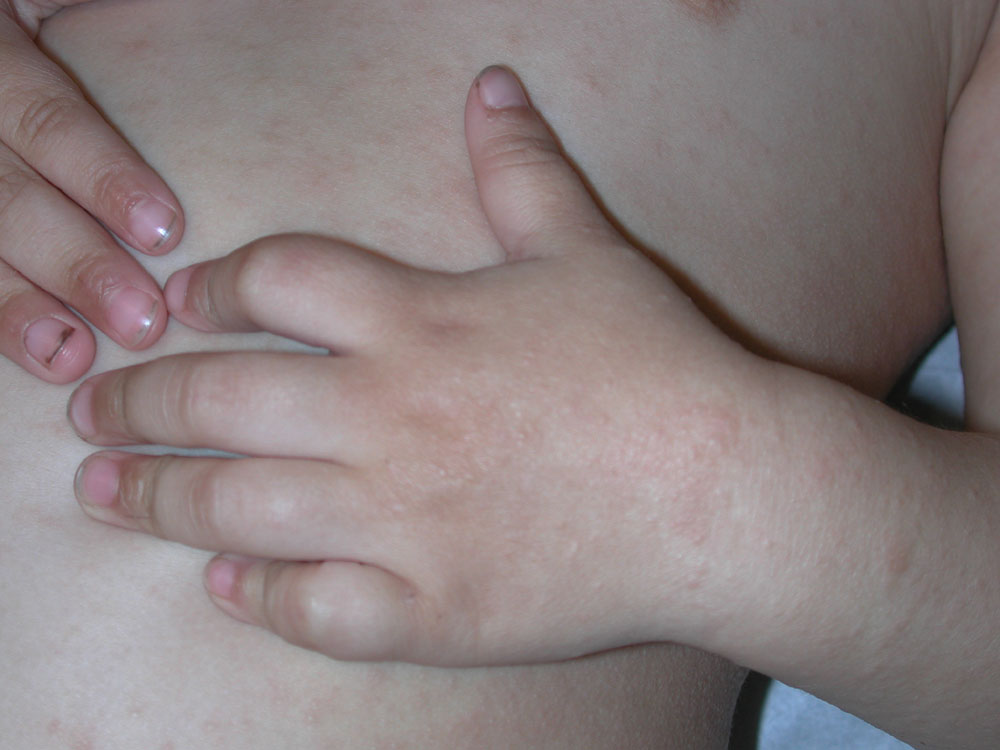 atopic dermatitis