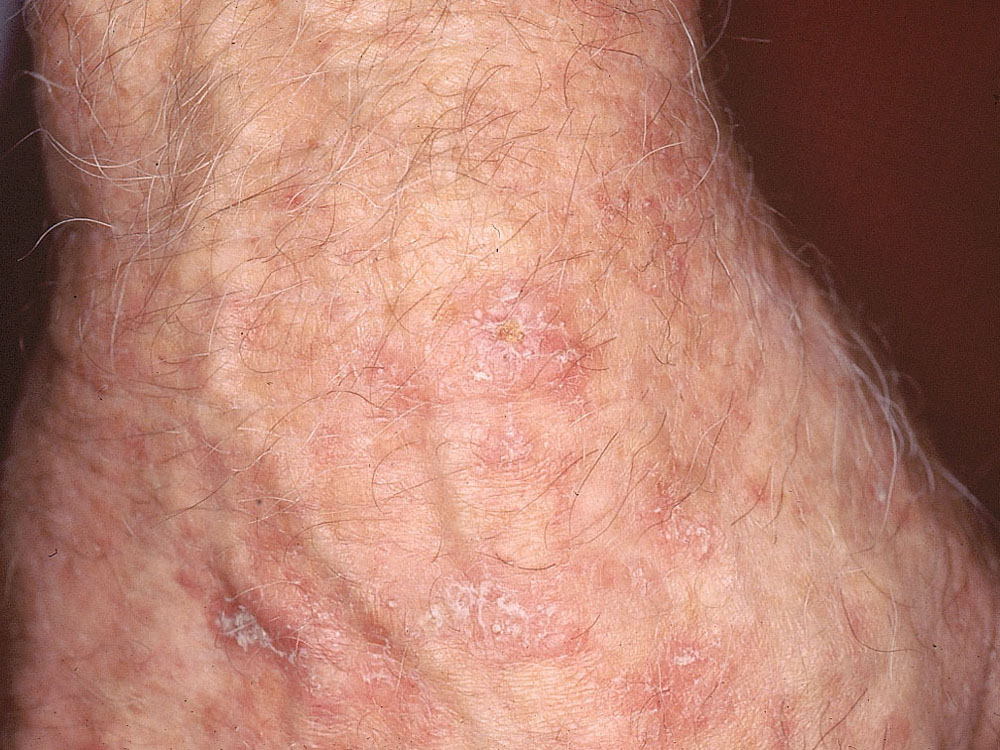 actinic keratosis