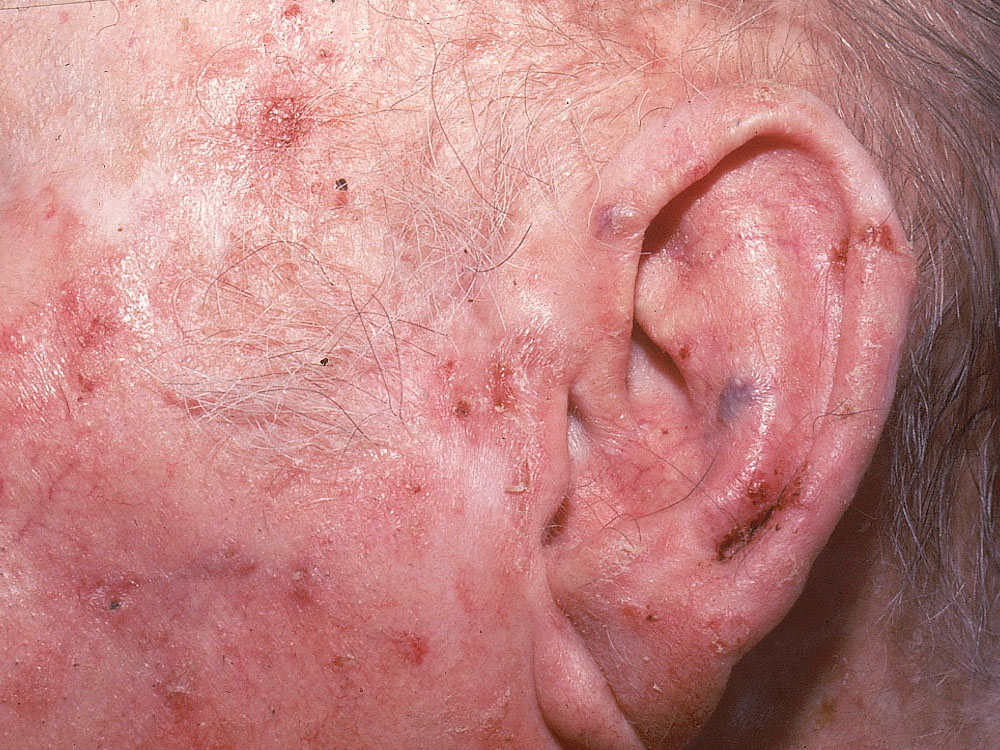 actinic keratosis