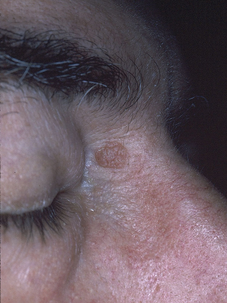 actinic keratosis