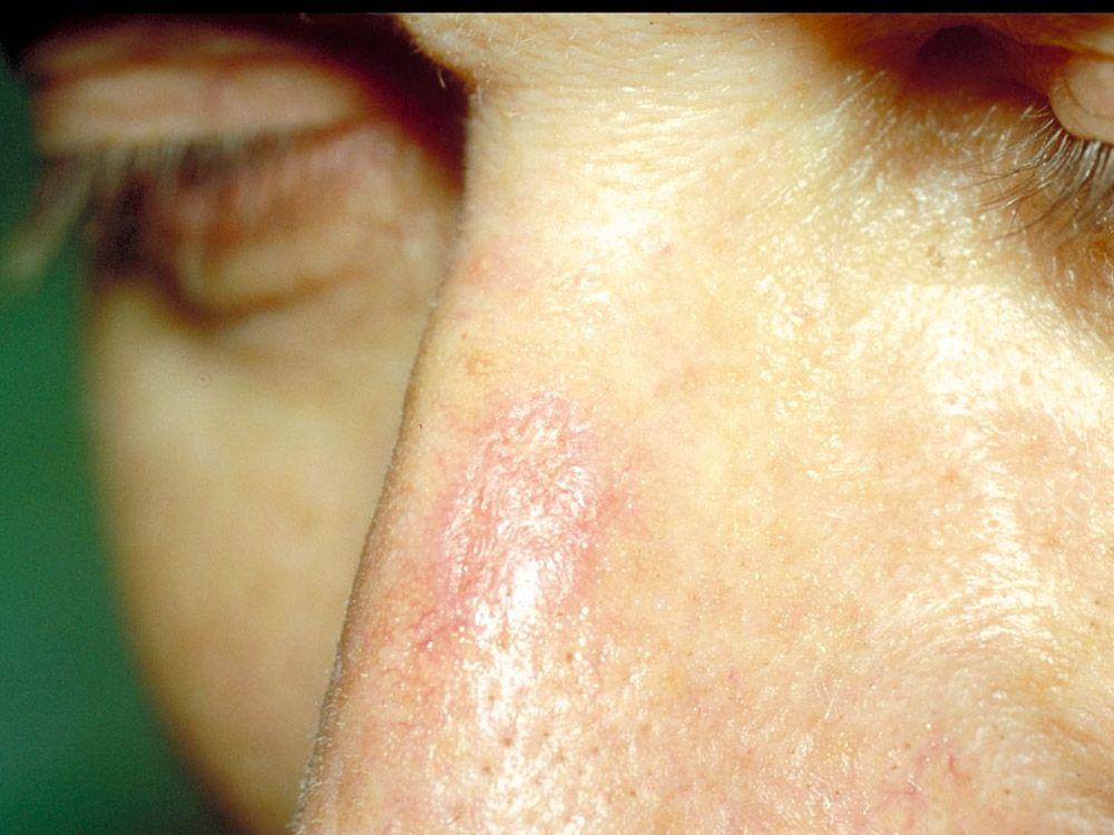 actinic keratosis