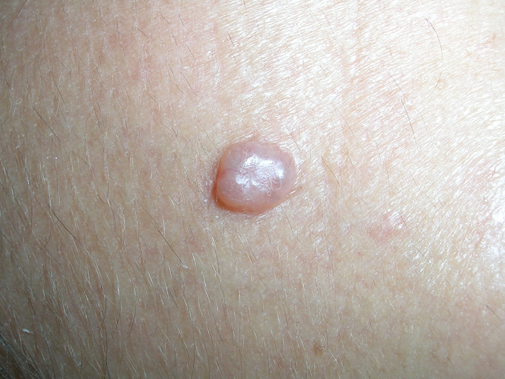 basal cell carcinoma, nodular