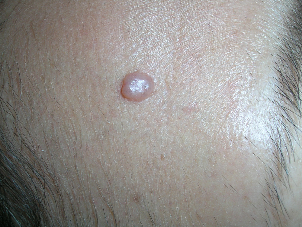 basal cell carcinoma, nodular