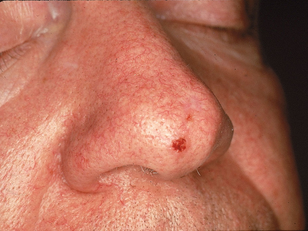 basal cell carcinoma, nodular