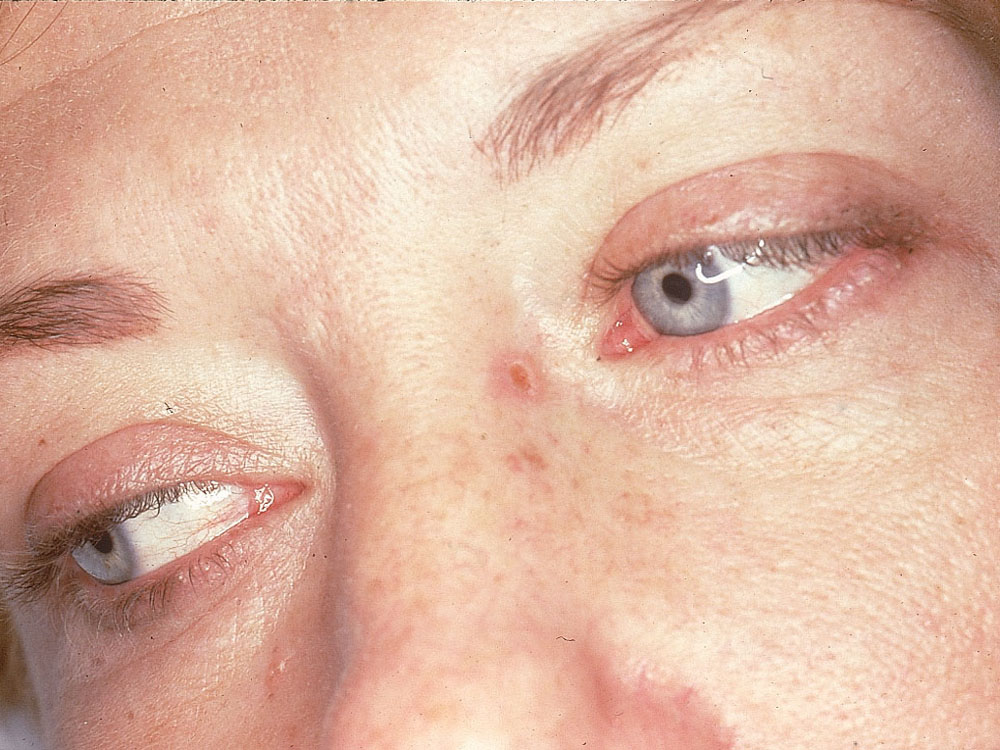 basal cell carcinoma, nodular