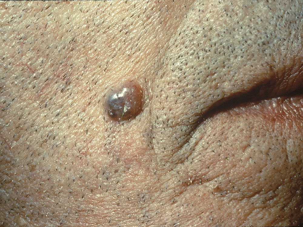 basal cell carcinoma, nodular