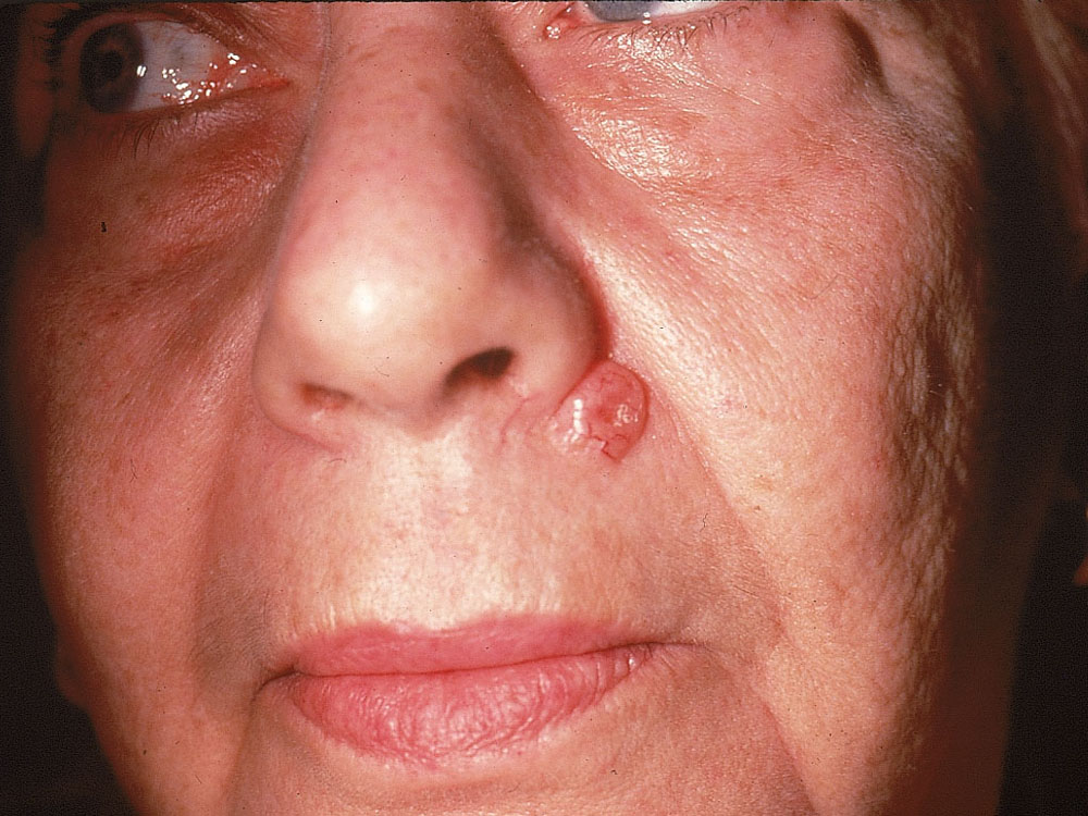 basal cell carcinoma, nodular