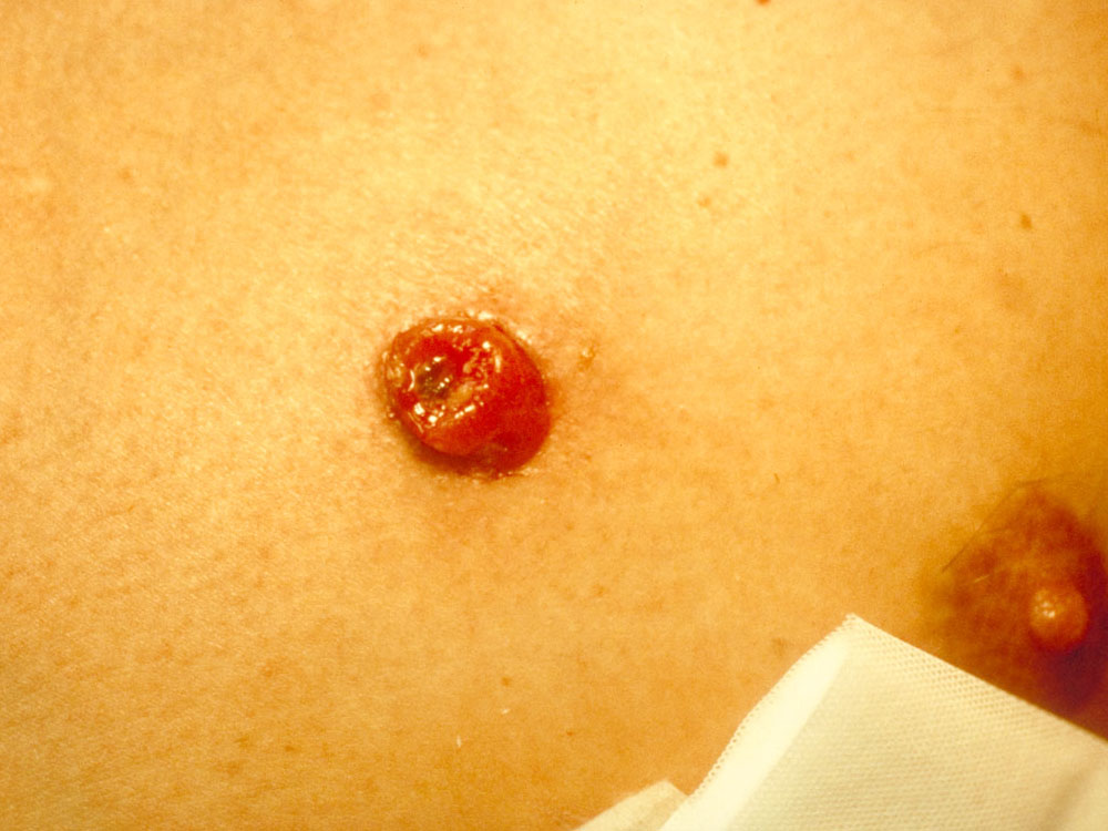 bacillary angiomatosis, cutaneous