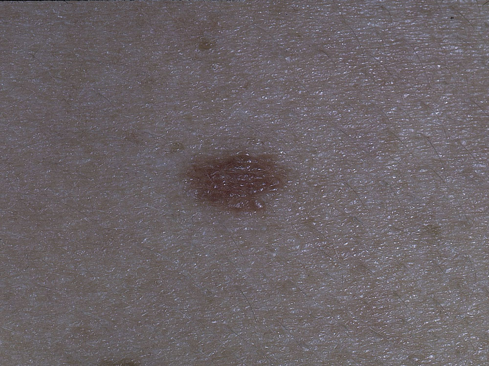 nevus, dysplastic