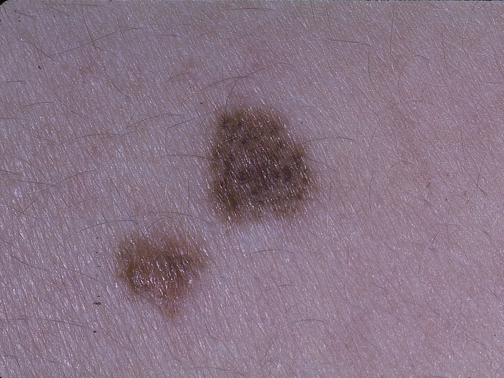nevus, dysplastic