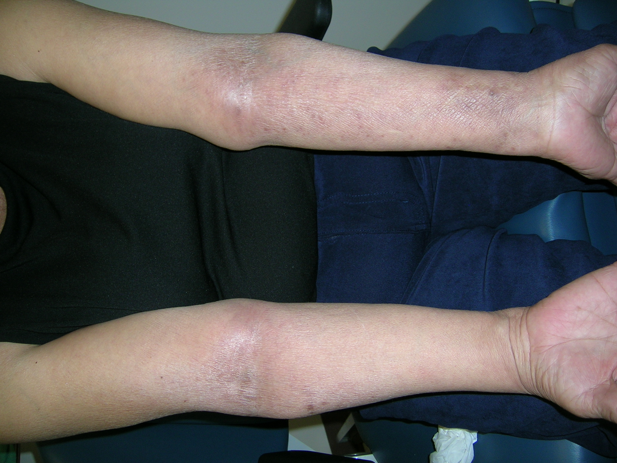 atopic dermatitis