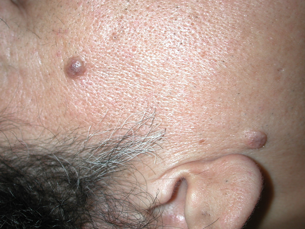 nevus, dermal