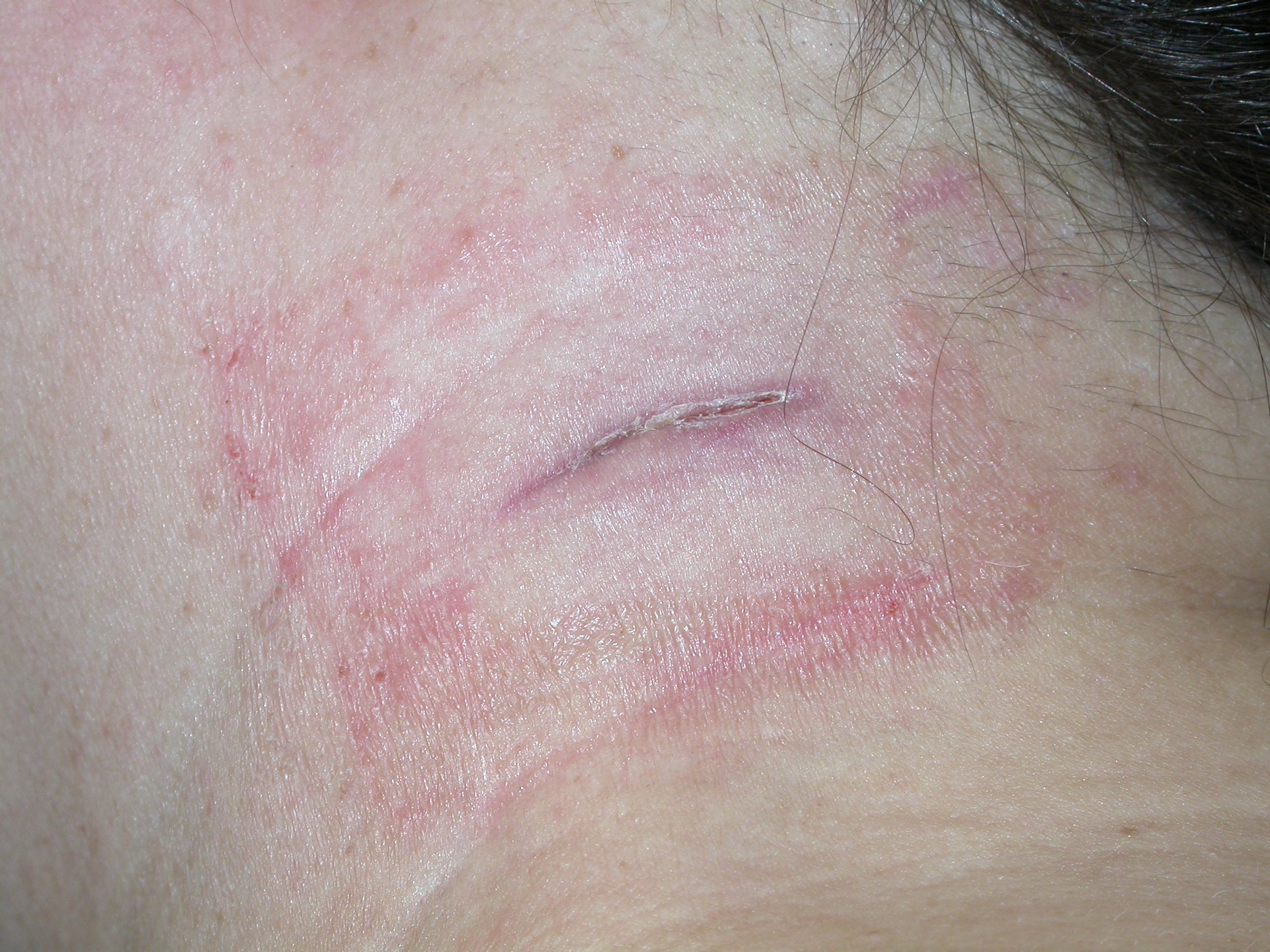 contact dermatitis, irritant