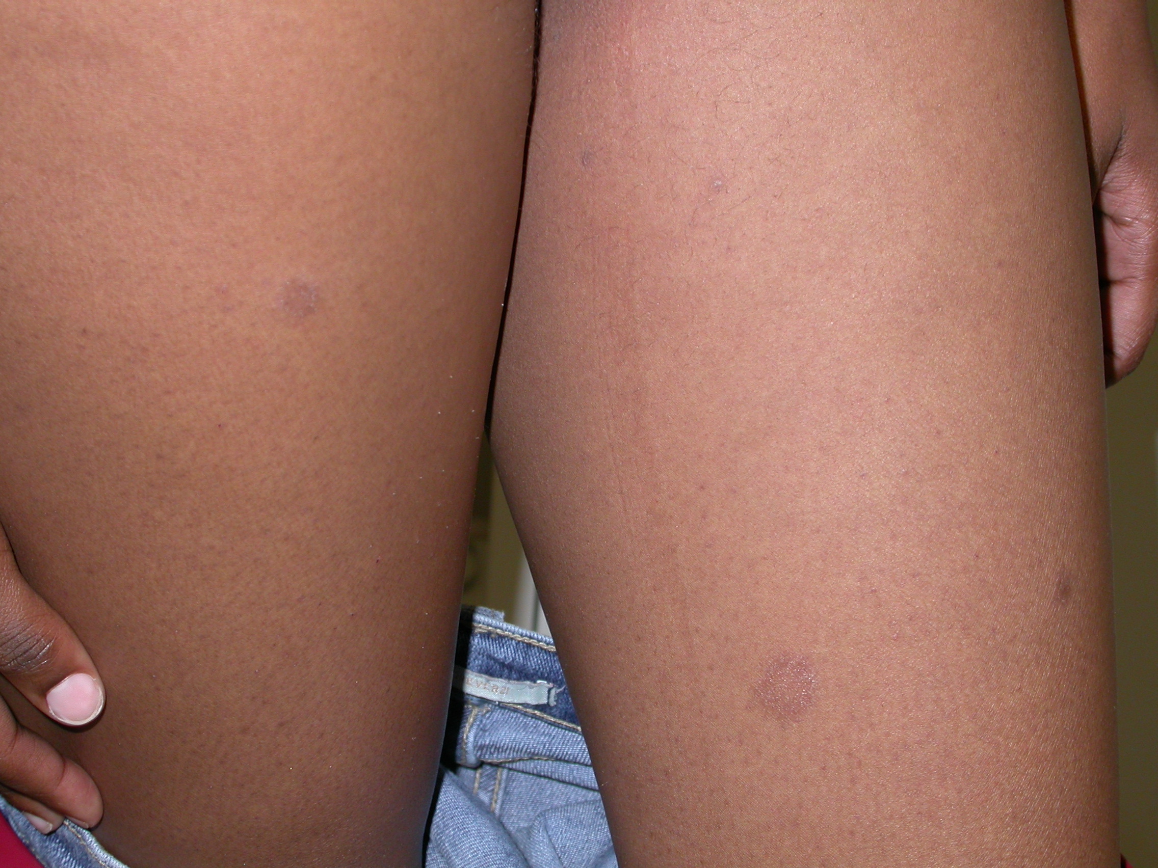 pityriasis rosea