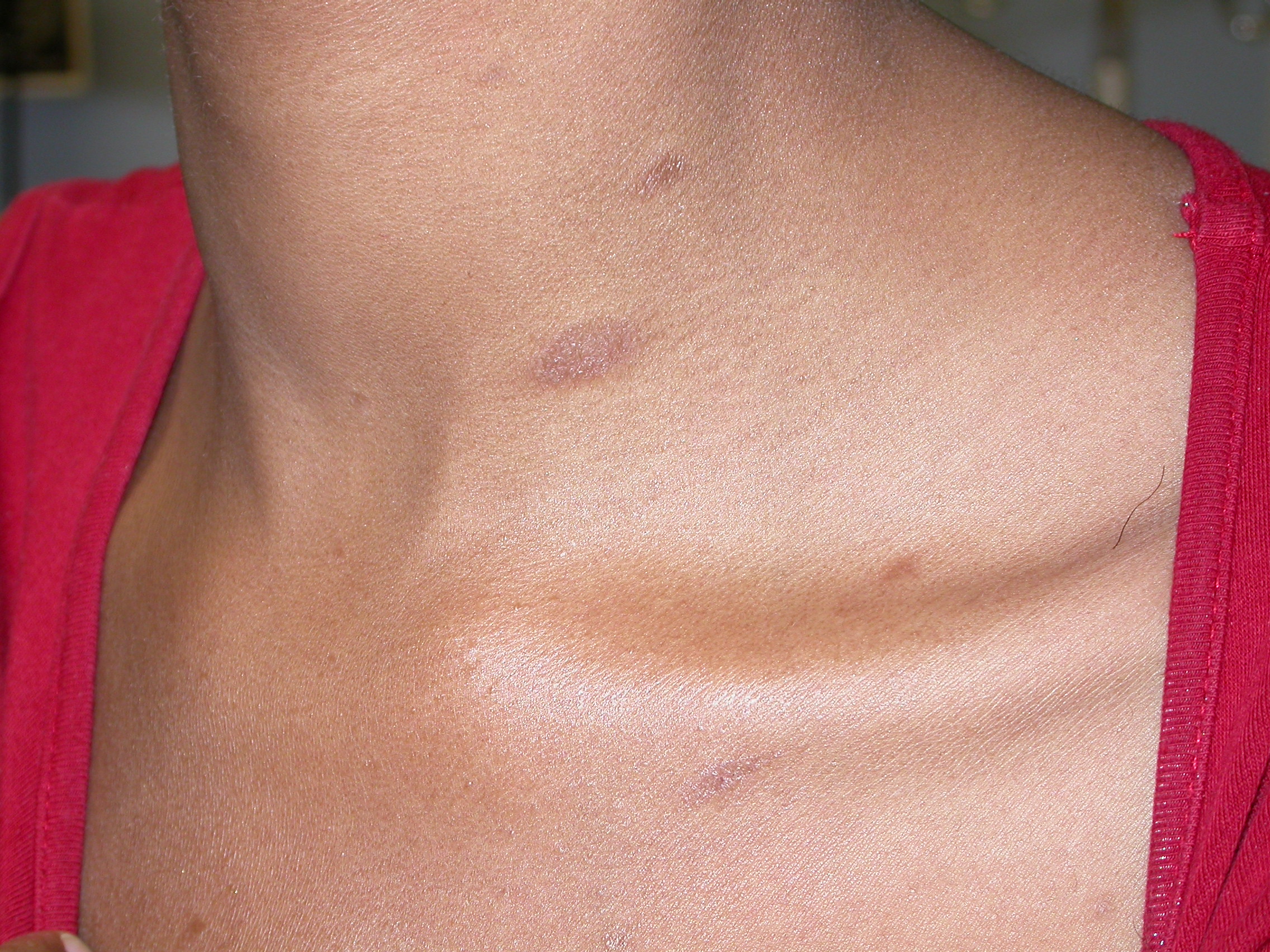 pityriasis rosea