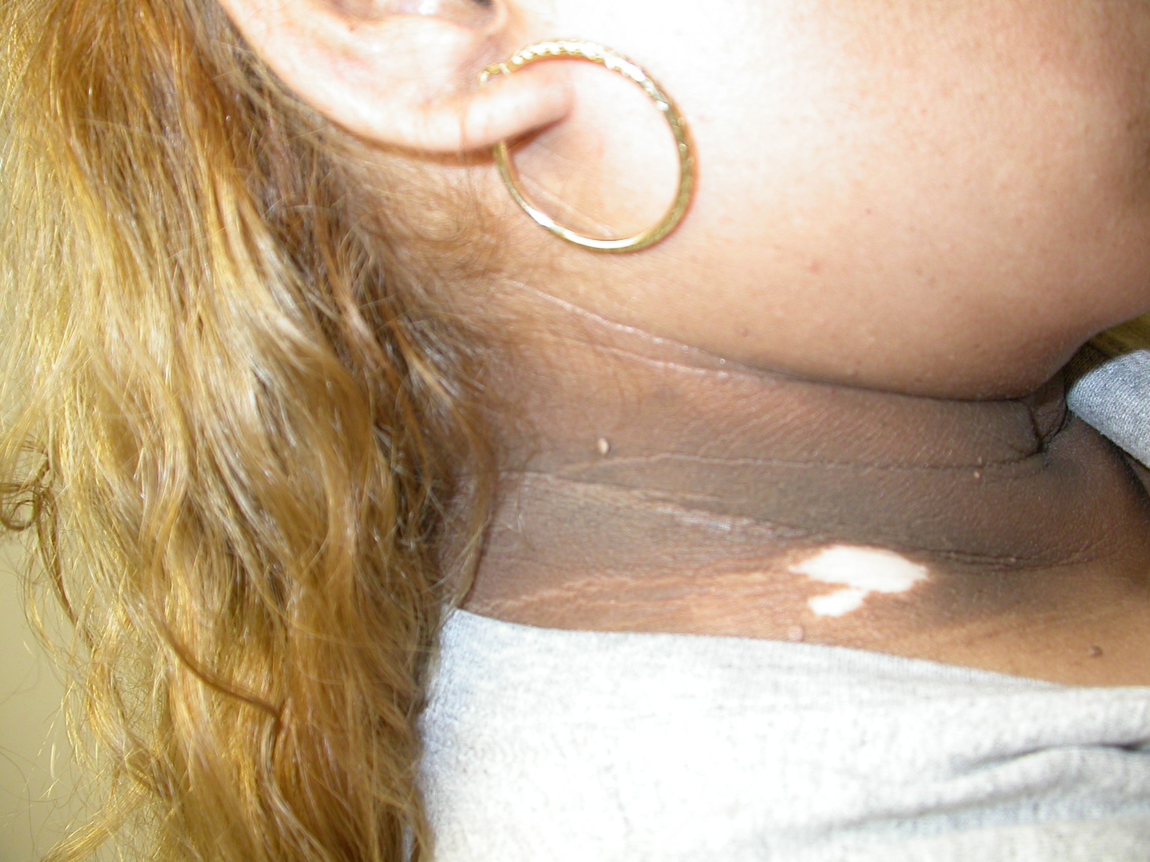 acanthosis nigricans