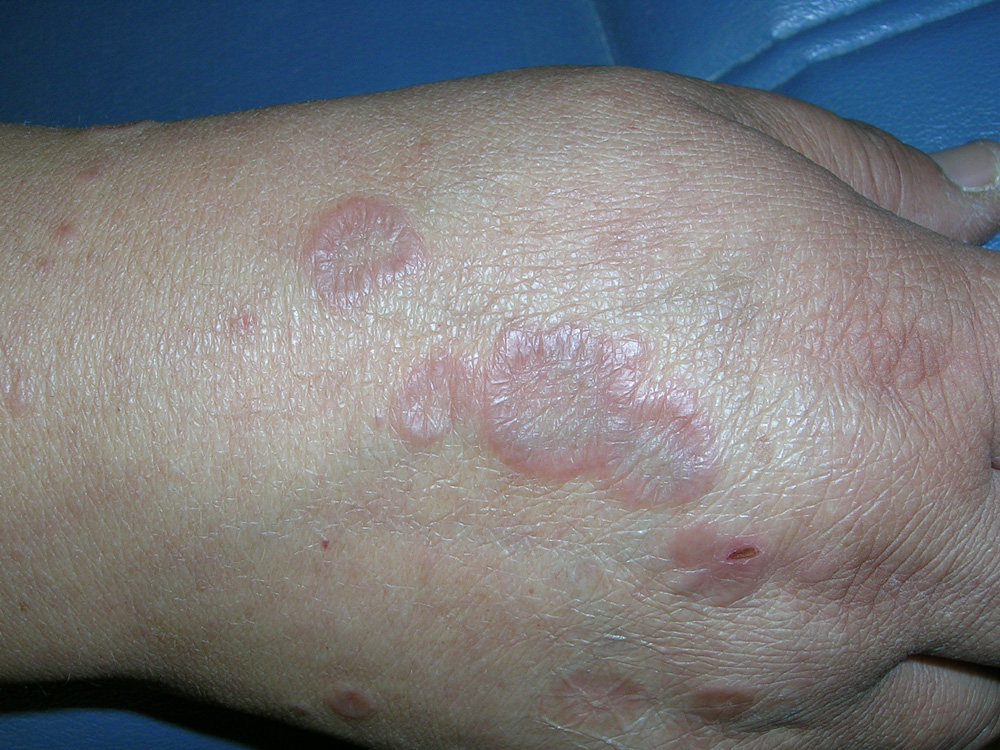 granuloma annulare