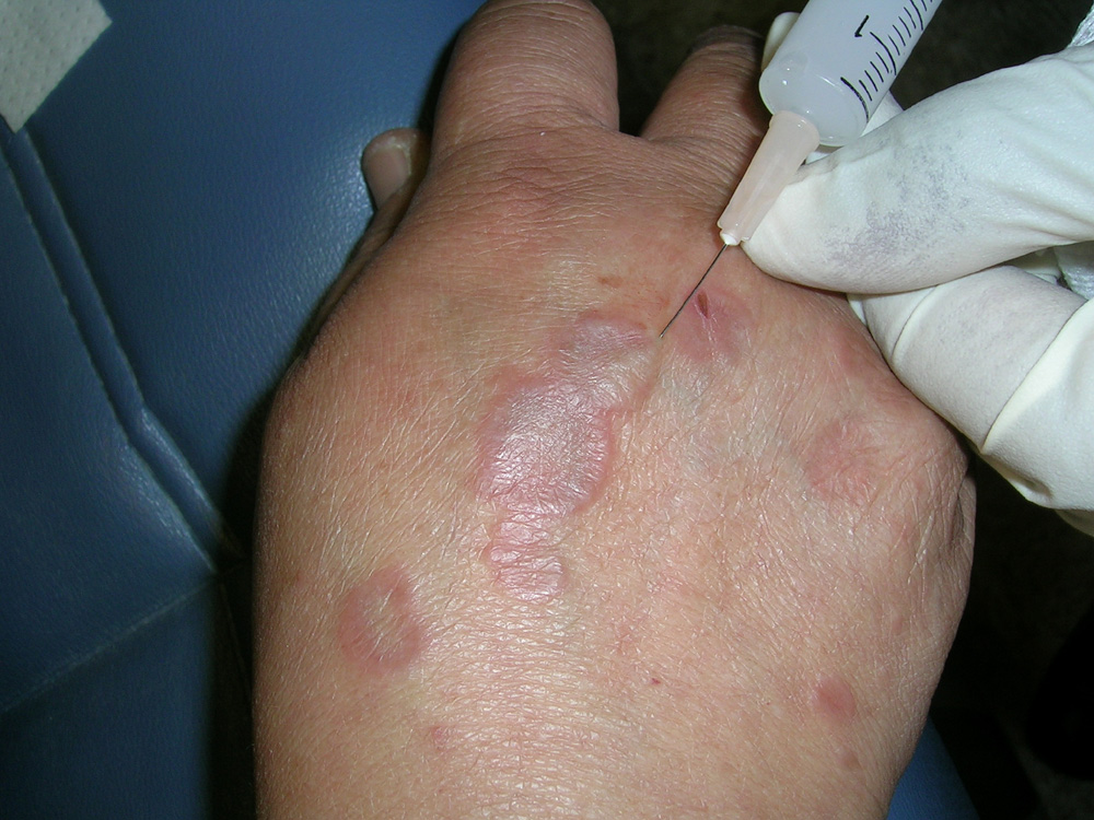 granuloma annulare