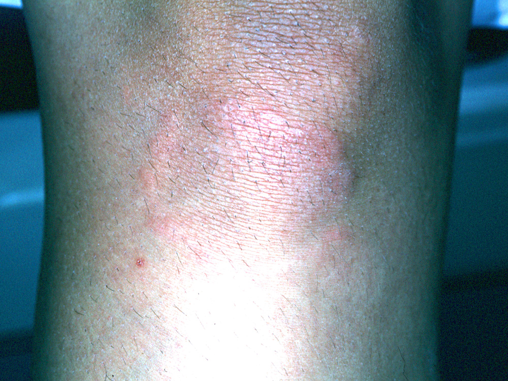 granuloma annulare
