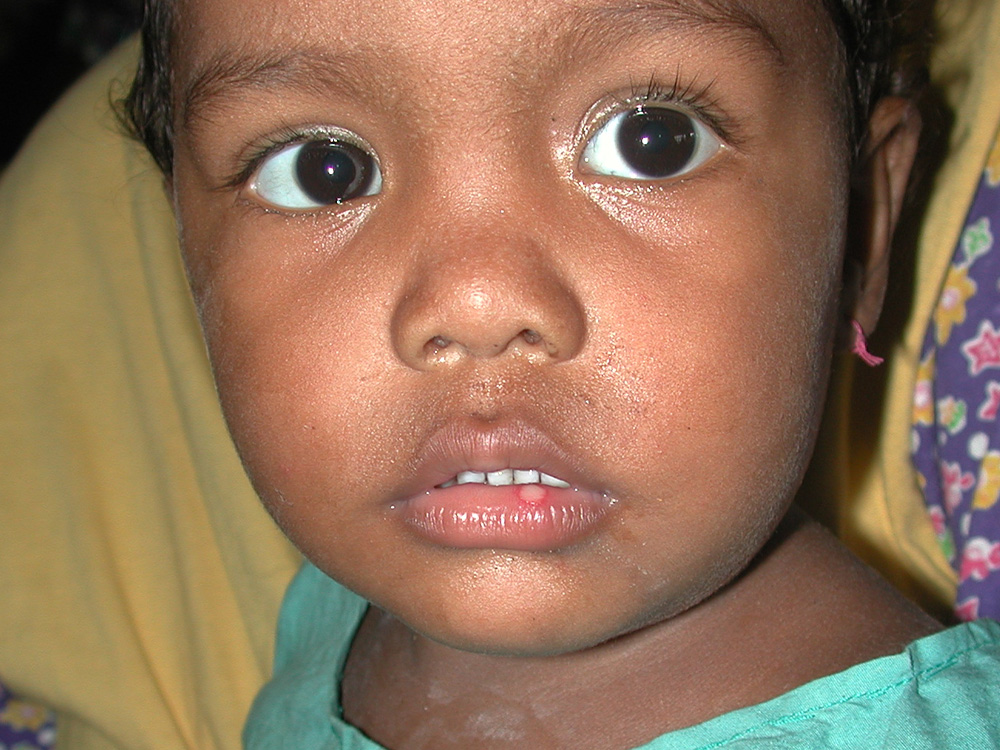 herpes simplex type I