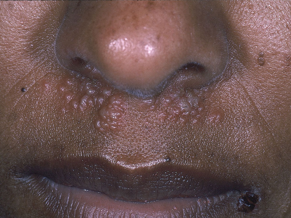 herpes simplex type I