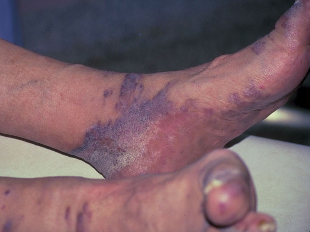 Kaposi's sarcoma