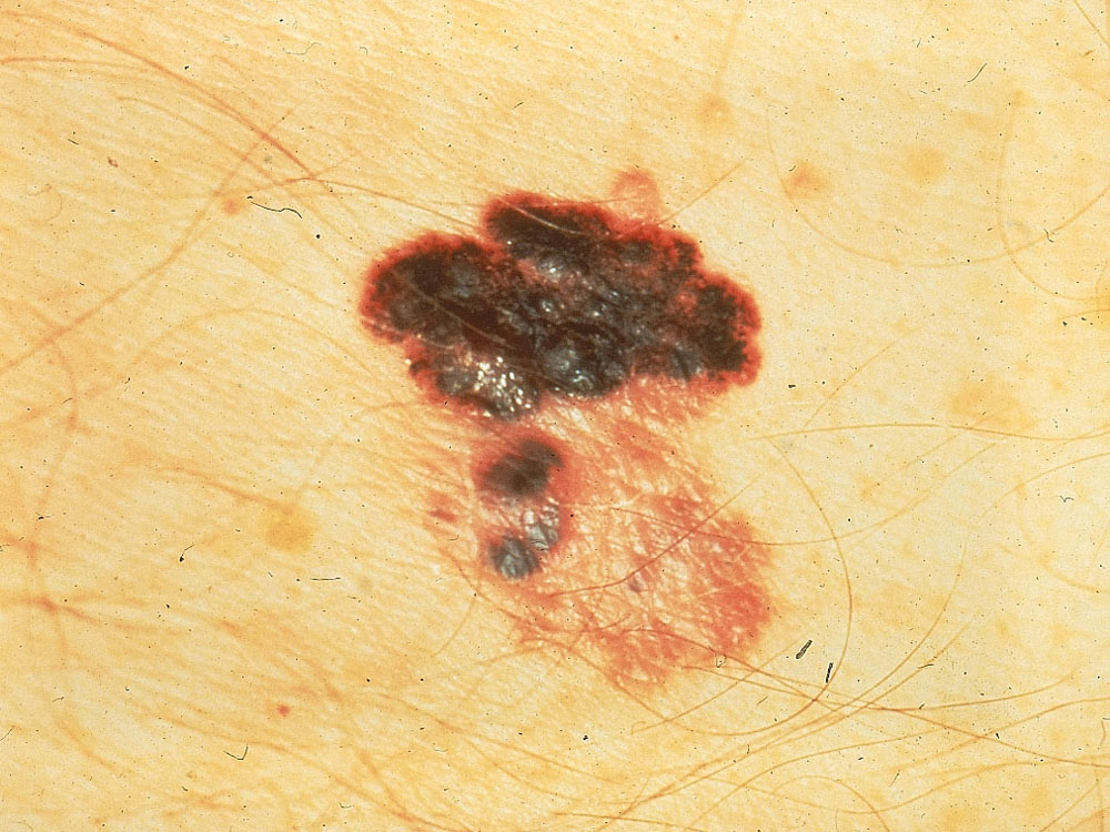 melanoma, superficial spreading