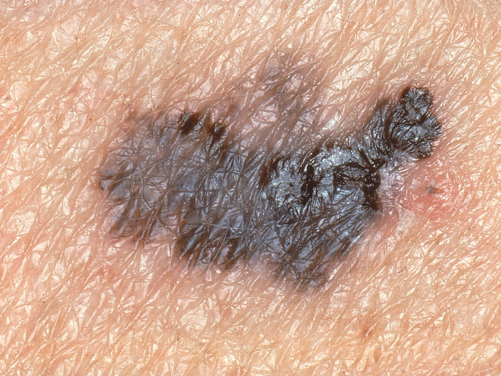 melanoma, superficial spreading