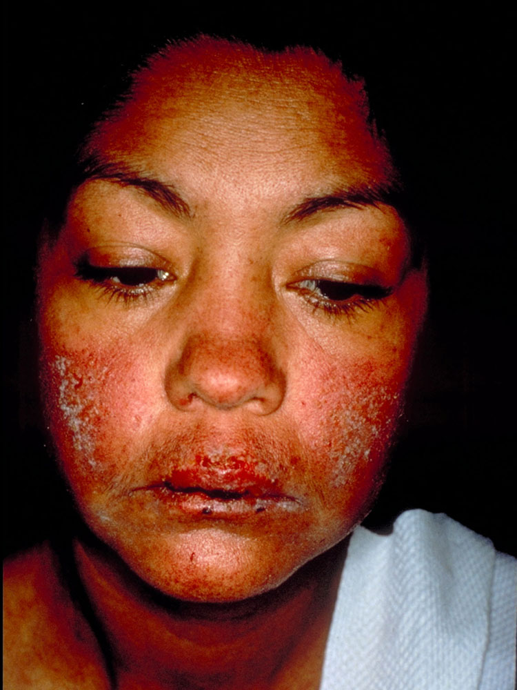 lupus erythematosus, systemic
