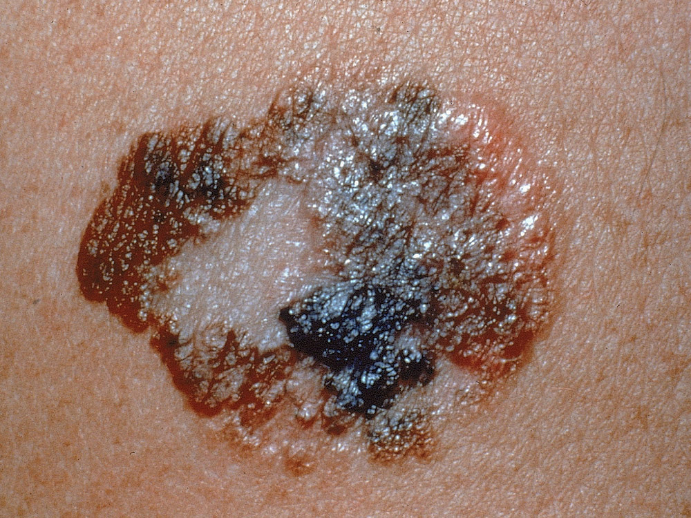 melanoma, superficial spreading