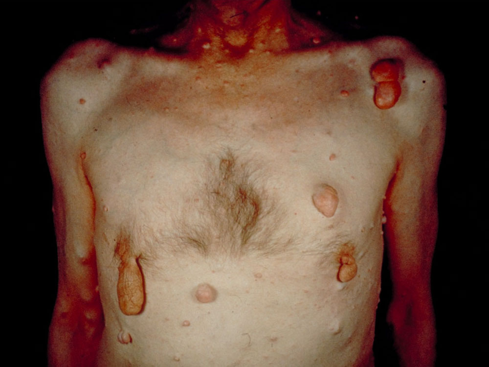 neurofibromatosis